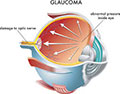 Glaucoma