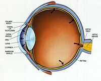 Glaucoma