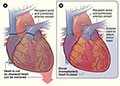 kidney transplant hospitals in india