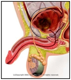 Bladder Cancer Treatment