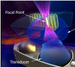 High Intensity Ultrasound Cost,High Intensity Focused Ultrasound India,Therapy Replace Conventional Surgery, High Intensity Focused Ultrasound Treatment, High Intensity, Hifu, High Intensity Focused Ultrasound, Hifu Specialist, Hifu Prostate Cancer, Miami Hifu, Hifu Treatment, Noninvasive, Surgery, Cryotherapy, Cryocare