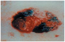 Malignant Melanoma Treatment, Malignant Melanoma India, Metastatic Melanoma India