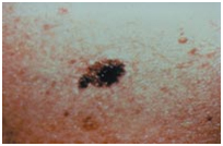 Malignant Melanoma Treatment, Malignant Melanoma India