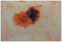 Malignant Melanoma India, Metastatic Melanoma India, Melanoma Treatment India, Cutaneous Melanoma India