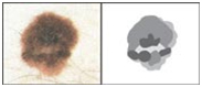 Malignant Melanoma India, Metastatic Melanoma India, Cutaneous Melanoma India, India Hospital Tour India