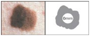 Malignant Melanoma Treatment, Metastatic Melanoma India, Cutaneous Melanoma India