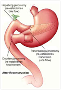 Pancreatic Cancer, Pancreatic Cancer Research India, Symptoms India