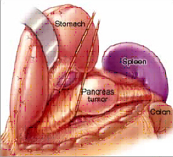 Pancreatic Cancer, Pancreatic Cancer Treatment India, Pancreatic Cancer Research India, Pancreatic Cancer Treatment India