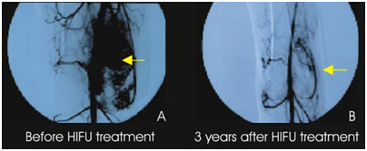 Hifu Cancer Treatment Mumbai India,Hifu Bone Cancer Treatment India, Hifu Cancer Bone Treatment Mumbai India, Pancreatic Cancer Prognosis, Symptoms, Stages, Causes And Treatment, Hifu Bone Cancer Treatment Hyderabad India, Hifu, Hifu, Hifu Cancer Treatment, Hifu Private Patient Hospital, High Intensity Focused Ultrasound, Hifu, Hifu, Liver Cancer Treatment, Pancreatic Cancer India