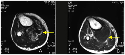 Hifu Cancer Treatment Mumbai India,Hifu Bone Cancer Treatment India, Hifu Cancer Bone Treatment Mumbai India, Pancreatic Cancer Prognosis, Symptoms, Stages, Causes And Treatment, Hifu Bone Cancer Treatment Hyderabad India, Hifu, Hifu, Hifu Cancer Treatment, Hifu Private Patient Hospital, Hifu Treatment, Liver Cancer Treatment, Pancreatic Cancer India