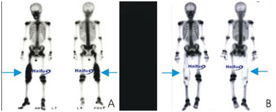 Hifu Cancer Symptoms, Stages, Causes And Treatment, Hifu Bone Cancer Treatment Hyderabad India, Hifu, Hifu, Hifu Cancer Treatment, Hifu Private Patient Hospital, Hifu Treatment, High Intensity Focused Ultrasound, Hifu, Hifu, Liver Cancer Treatment, Pancreatic Cancer India