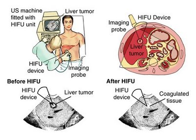 Hifu Cancer Treatment Mumbai India,Hifu Treatment Liver Cancer India, High Intensity Focused Ultrasound (Hifu), New Software, Non-Invasive Prostate Treatment, Prostate Cancer, Hifu Treatment Liver Cancermumbai India, Radical Surgery, Incontinence, Impotence, Hormonal Treatment, Sexual Ability, Liver Cancer, Hepatocarcinoma, Hifu Treatment Liver Cancer Delhi India, Liver Cancer Treatment , Alternative Liver Cancer Treatment, Hifu, Hifu Cancer Treatment, Hifu Private Patient Hospital, Hifu Treatment, Hifu Treatment Liver Cancer Kolkata India, Liver Cancer Therapy, Alternative Liver Cancer Therap