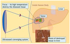 Hifu Cancer Treatment Mumbai India,Hifu Treatment Pancreatic Cancer India, Hifu Treatment Pancreatic India, Cancer, Treatment, Hifu, High, Intensity, Focused, Ultrasound, Hifu Treatment Pancreatic Cancer Mumabi India,  Trials, Prostate, Kidney, Liver, Pancreas, Pancreatic, Sound, Waves, Ablation, Focal, Prostate Cancer, Kidney Cancer, Liver Cancer, Liver Cancer Therapy, Hifu Treatment Pancreatic Cancer Delhi India