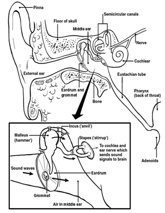 Eardrum Surgery Patch Hole