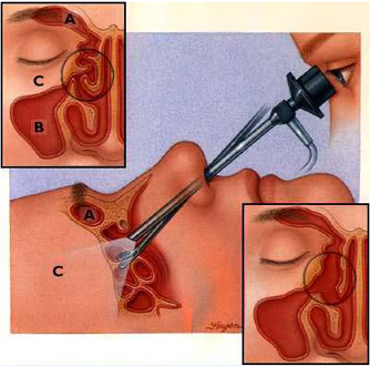 Nasal polyps steroid treatment side effects