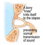 Stapedectomy Surgery, Stapedectomy, Mastoidectomy, Stapedectomy Surgery Center, Stapes Surgery