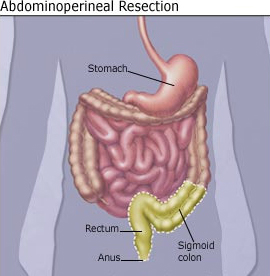 Abdomino Perineal Resection Surgery India offers info on Cost Abdominal-Perineal Surgery India
