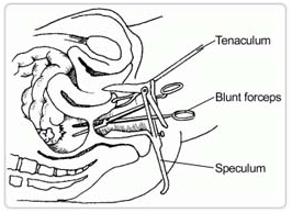 Abscess Pelvic Surgery India offers info on Cost Abscess Pelvic Specialist Surgeon India, Pelvic Abscess India