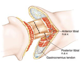 Best Price Surgery Amputation-Below Knee India-New Delhi-Mumbai India