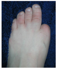 Amputation - Toe Surgery India offers info on Cost Amputation - Toe Surgery India, Low Cost Amputation - Toe Surgery Delhi India, Amputation - Toe Surgery Hospital Delhi India