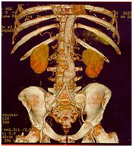 Aortic Aneurysm Surgery offers info on Aortic Aneurysm India, Aortic Aneurysm Surgery India, Treatment For Aortic Aneurysms India