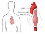 Aortic Aneurysm Surgery India, Treatment For Aortic Aneurysms India