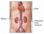 Aortic Aneurysm Surgery offers info on Aortic Aneurysm India, Treatment For Aortic Aneurysms India