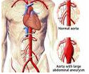 Treatment For Aortic Aneurysms India