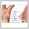 Breast Biopsy Surgery India, Breast Biopsy Surgery Mumbai India