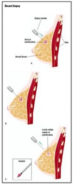 India Surgery-Breast Biopsy Mumbai offers info on Best Price For India Surgery-Breast Biopsy In New Delhi India, Breast Biopsy Surgery India