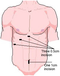 Cholecystectomy Gall Bladder Removal Surgery offers info on Laparoscopic Cholecystectomy India, Gallstones Symptoms India, Gall Bladder India