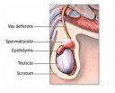 Epididymal Cyst Removal Surgery India, Epididymal Cyst Removal Surgery Delhi India