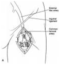 Femoral Embolectomy Surgery offers info on Femoral Embolectomy India, Femoral Embolectomy Surgery India