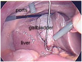 Gall Stone India, Gall Stones India, Gallbladder India, Gallbladder Removal India