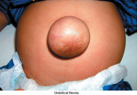 Hernia Repair Epigastric Surgery offers info on Hernia Repair Epigastric Surgery India, India Hospital Tour India, Hernia Repair Epigastric Surgery Hospital Delhi India