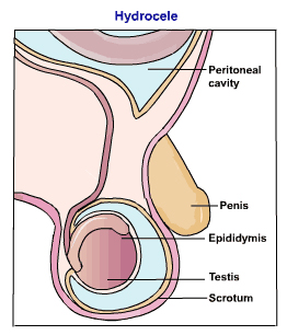 Hydrocele Surgery India, India Surgery Hydrocele Operation-Adult India, Best Price India Surgery Hydrocele Operation-Adult -Mumbai India