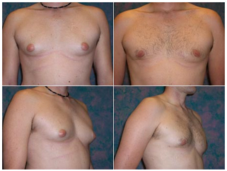 Mastectomy Male Subcutaneous Surgery offers info on Mastectomy India, Gynecomastia India