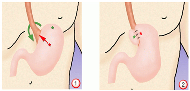 Reflux Surgery India, Reflux offers info on Reflux Surgery India, Reflux Disease India, GERD India