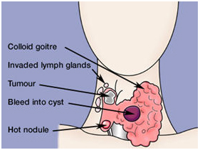 Thyroidectomy Surgery offers info on Thyroidectomy India, Thyroid Surgery India, Thyroid Cancer India, Thyroid Removal India