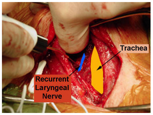 Thyroidectomy Surgery offers info on Thyroidectomy India, Thyroid Surgery India, Thyroidectomy Cancer India, Thyroid Removal India