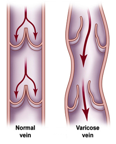 Vein Surgeon India, Varicose Vein India, Vein India, Veins India, Veins Surgery India