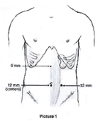 Kidney Surgery offers info on Kidney India, Kidney Surgery India, Laparoscopic Kidney Surgery India