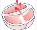 Aortic Valve Repair India, Aortic Stenosis, Valve Disease, Regurgitation