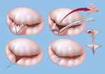 Aortic Valve Repair India, Aortic Stenosis, Valve Disease, Regurgitation, AVR