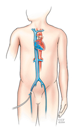 Asd Closure, Asd Closure Surgery India, Atrial Septal Defect Closure