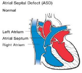 Asd