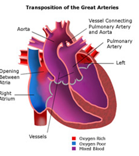 Child Heart Surgery India, Child Open Heart Surgery, Mini-Invasive