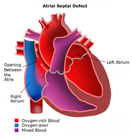 Child Heart Surgery, Child Open Heart Surgery, Children's Heart Surgery, Heart, Pediatric