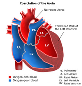 Child Heart Surgery India, Mini-Invasive, Heart, Pediatric