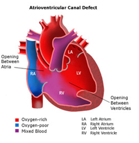 Child Heart Surgery, Child Heart Surgery India, Mini-Invasive, Children's Heart Surgery, Pediatric